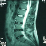 hern-disc-mri